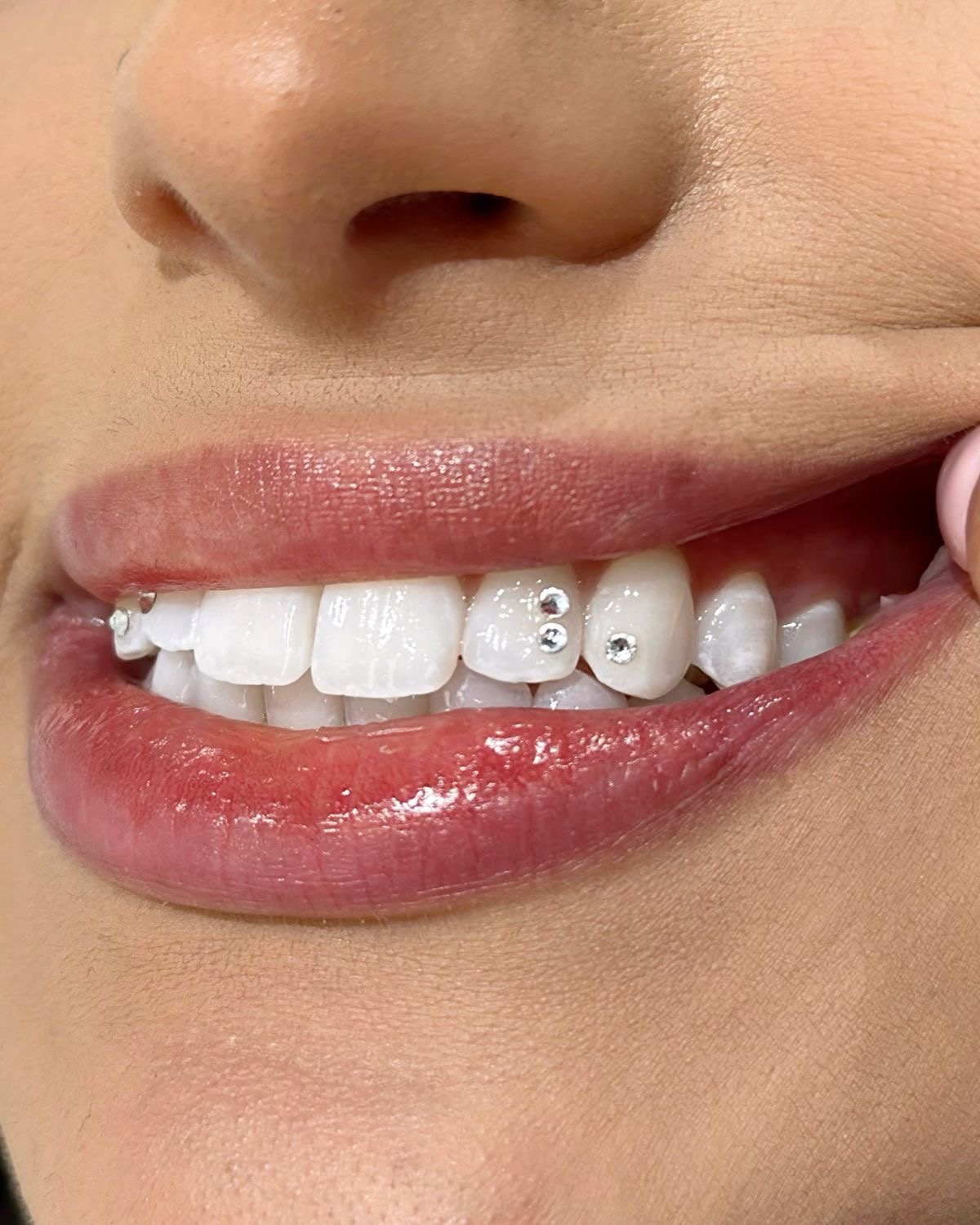 Tooth gems